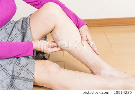 Lower extremity varix Lower extremity varix 18914220