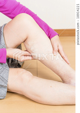 Lower extremity varix Lower extremity varix 18914221