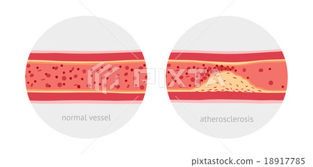 Atherosclerosis in vessels 18917785