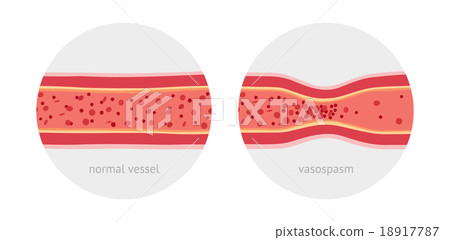 Healthy and sick human vessels 18917787