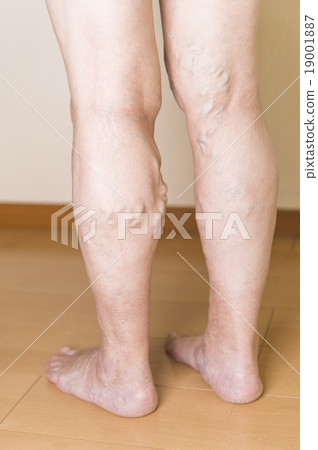 Lower extremity varix 19001887