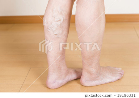 Lower extremity varix Lower extremity varix 19186331