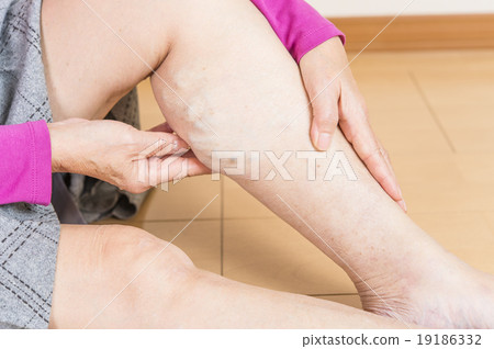 Lower extremity varix Lower extremity varix 19186332