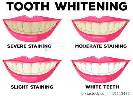 Process of tooth whitening 19215451