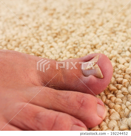 Damaged toenail 19224452