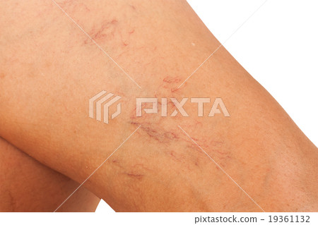 Varicose veins on the legs of middle-aged women. Varicose veins on the legs of middle-aged women. 19361132