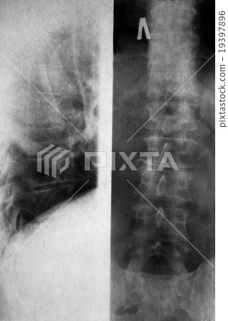 X-ray picture X-ray picture 19397896