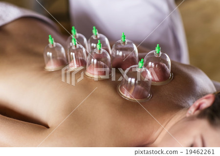Woman with cupping treatment on back Woman with cupping treatment on back 19462261