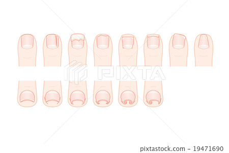 Foot trouble and rolled nail 19471690