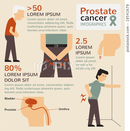 Prostate cancer infographics - Stock Illustration [19541679] - PIXTA