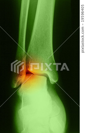 x-ray image of human foot joint , back view x-ray image of human foot joint , back view 19596405