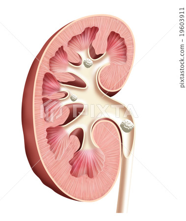 Kidney stone ureter stone 19603911