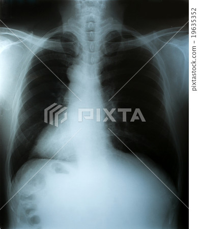 X-Ray image, chest men for medical diagnosis. X-Ray image, chest men for medical diagnosis. 19635352