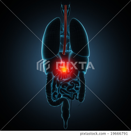 Disease illustration of human stomach Disease illustration of human stomach 19666791