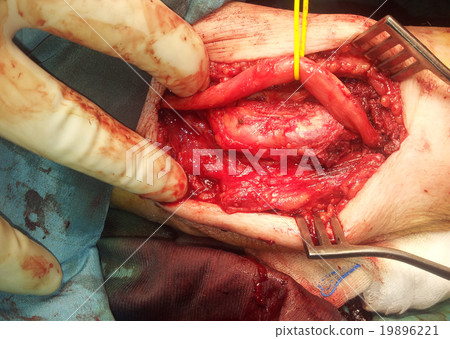 ulnar nerve surgery 19896221