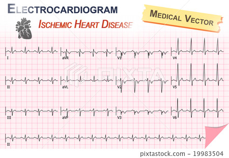 Electrocardiogram ( ECG , EKG ) Electrocardiogram ( ECG , EKG ) 19983504