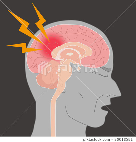 Headache, cerebral infarction, brain haemorrhage image illustration 20018591