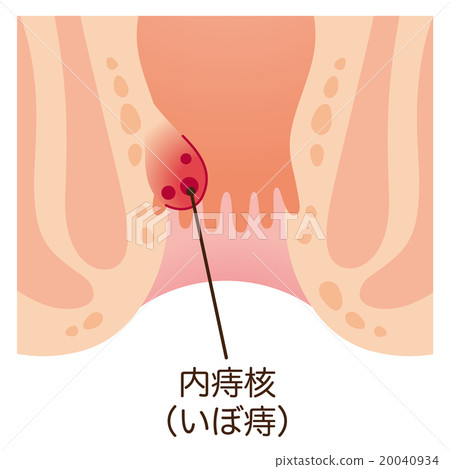 痔瘡部分 20040934