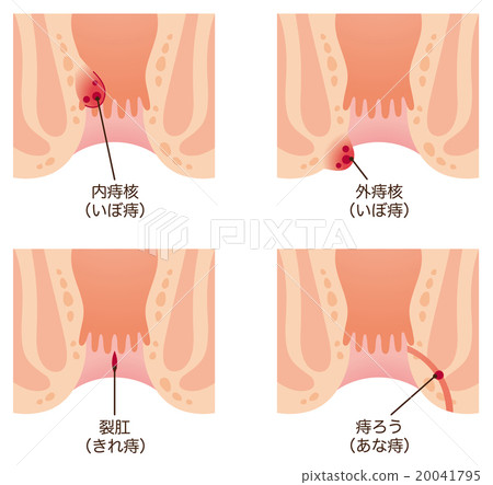 Hemorrhoid anal section Hemorrhoid anal section 20041795