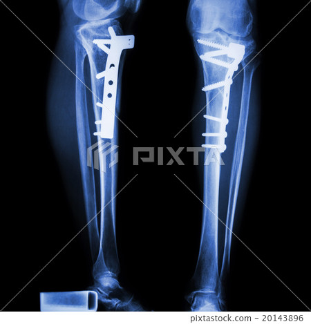 fracture tibia(leg bone) 20143896