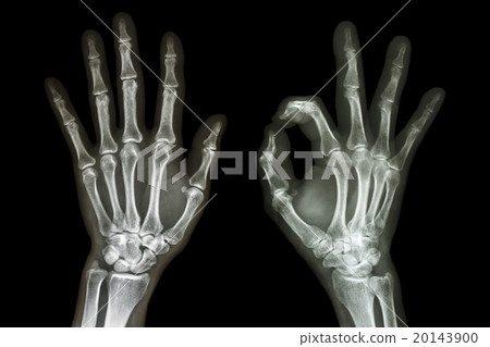 X-ray both hands with OK sign 20143900