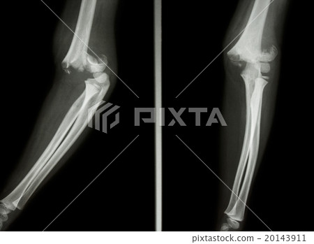 Supracondylar humerus fracture Supracondylar humerus fracture 20143911