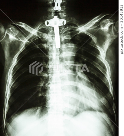 human chest with tracheotomy tube human chest with tracheotomy tube 20143912