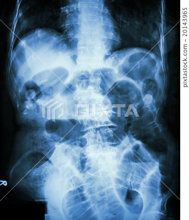 Small bowel obstruction. Film X-ray abdomen supine Small bowel obstruction. Film X-ray abdomen supine 20143965