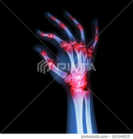 "Rheumatoid Arthritis , Gouty Arthritis" 20144025