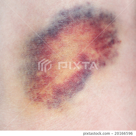 Bruise 20166596