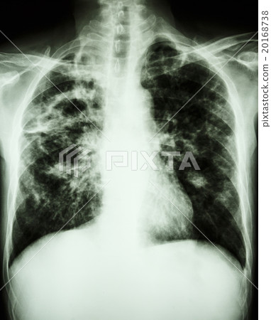 Pulmonary Tuberculosis 20168738