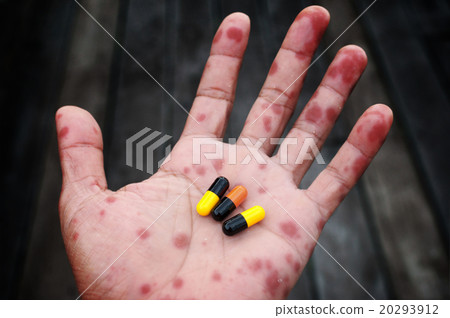 illness hand(scarlet fever) with drug illness hand(scarlet fever) with drug 20293912