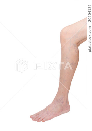 Woman leg with varicose veins on white background 20304123
