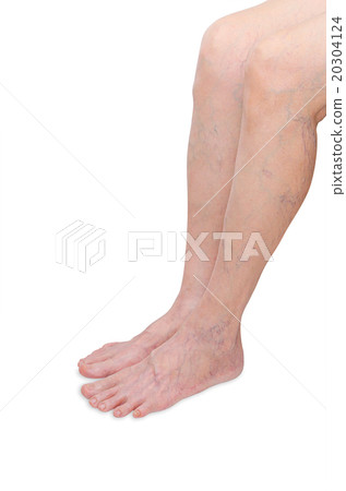 Woman legs with varicose veins on white background Woman legs with varicose veins on white background 20304124