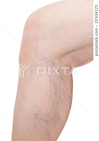 Close up woman legs with varicose veins on white Close up woman legs with varicose veins on white 20304125