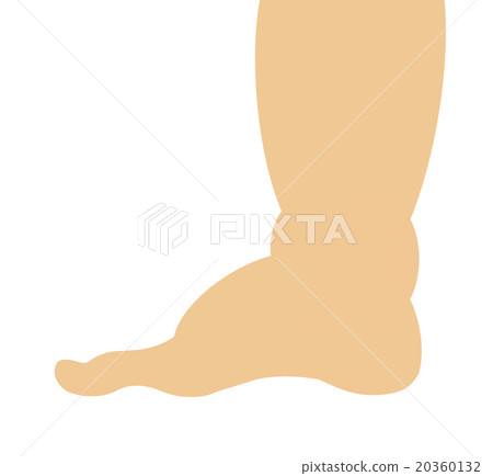 Swollen legs 20360132