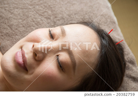 Acupuncture Acupuncture 20382759