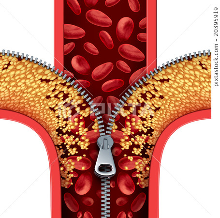 Atherosclerosis Therapy Atherosclerosis Therapy 20395919