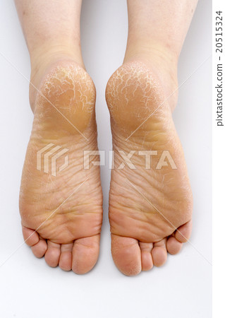 Cracked heel 20515324