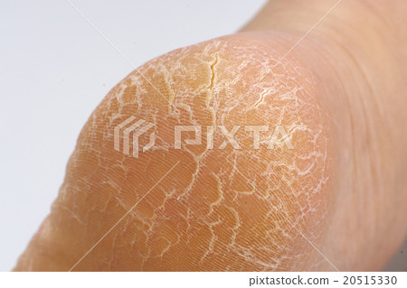 Cracked heel 20515330