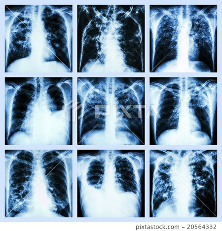 Collection of lung disease  20564332