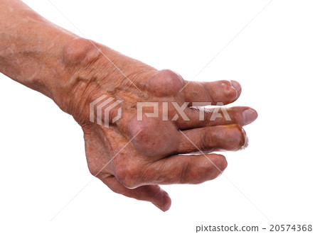 Man with a diagnosis of polyarthritis . 20574368