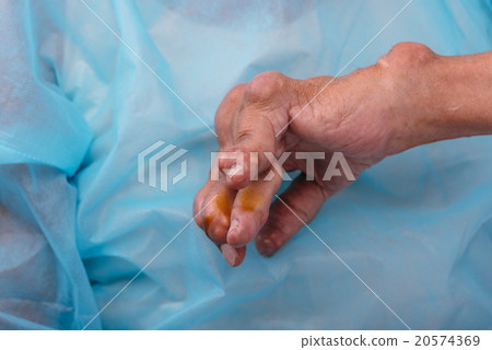 Man with a diagnosis of polyarthritis . 20574369