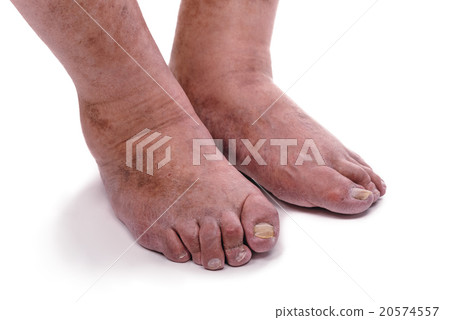 Man with a diagnosis of polyarthritis . Man with a diagnosis of polyarthritis . 20574557