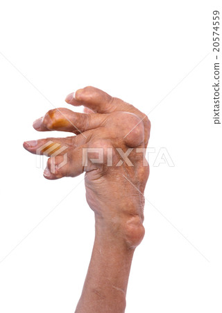 Man with a diagnosis of polyarthritis . 20574559