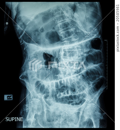 Small bowel obstruction Small bowel obstruction 20585981