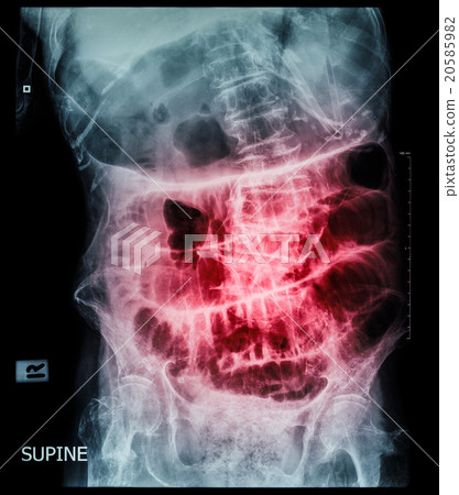 Small bowel obstruction 20585982