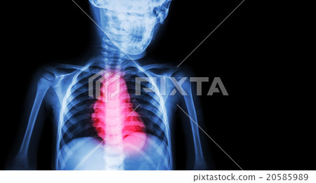 Ischemic Heart Disease , Myocardial Infarction 20585989