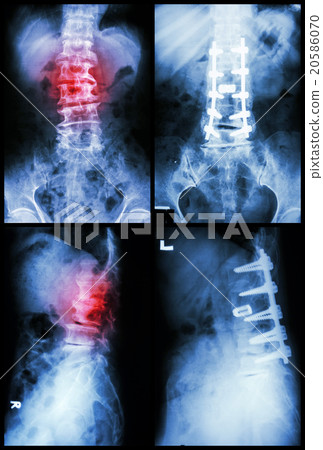 "Spondylosis and Spondylolisthesis"  20586070