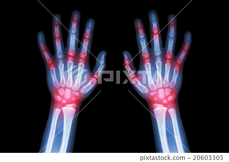 Rheumatoid arthritis , Gout arthritis  20603305